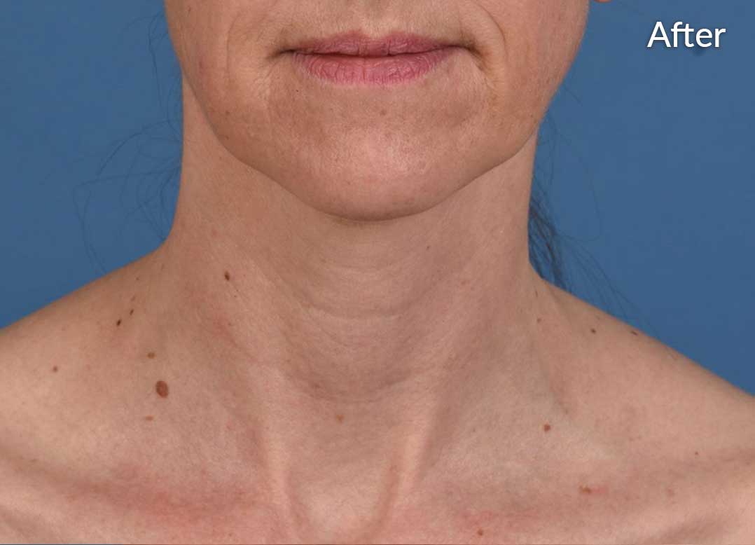 Before image