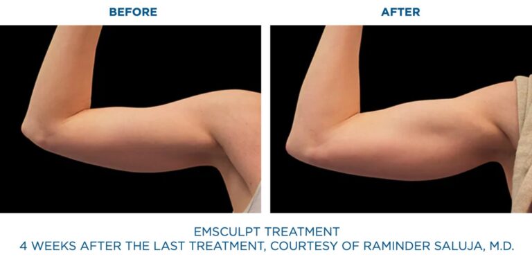 BTL-Emsculpt-Neo-Results-Arms-Biceps-Triceps