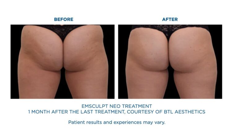 BTL-Emsculpt-Neo-Results-Buttocks