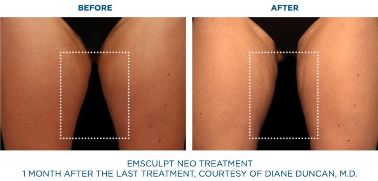 BTL-Emsculpt-Neo-Results-Legs
