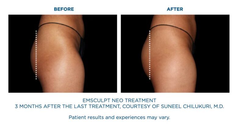 BTL-Emsculpt-Neo-Results-Stomach-Abs-2