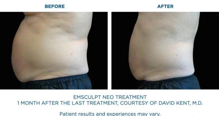 BTL-Emsculpt-Neo-Results-Stomach-abs-3