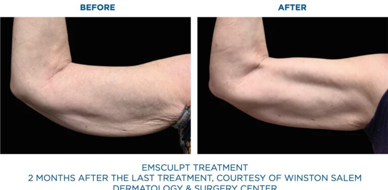 BTL-Emsculpt-Neo-Results-Triceps-Arms