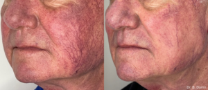 lumecca-before-after-dr-b-dornn-preview-1-768x332