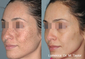 lumecca-before-after-dr-m-taylor-preview-1