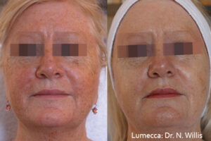 lumecca-before-after-dr-n-willis-preview-8