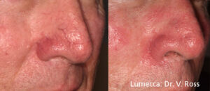 lumecca-before-after-dr-v-ross-preview-1