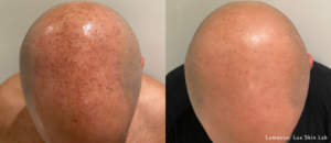 lumecca-before-after-lux-skin-lab-preview-1-768x332